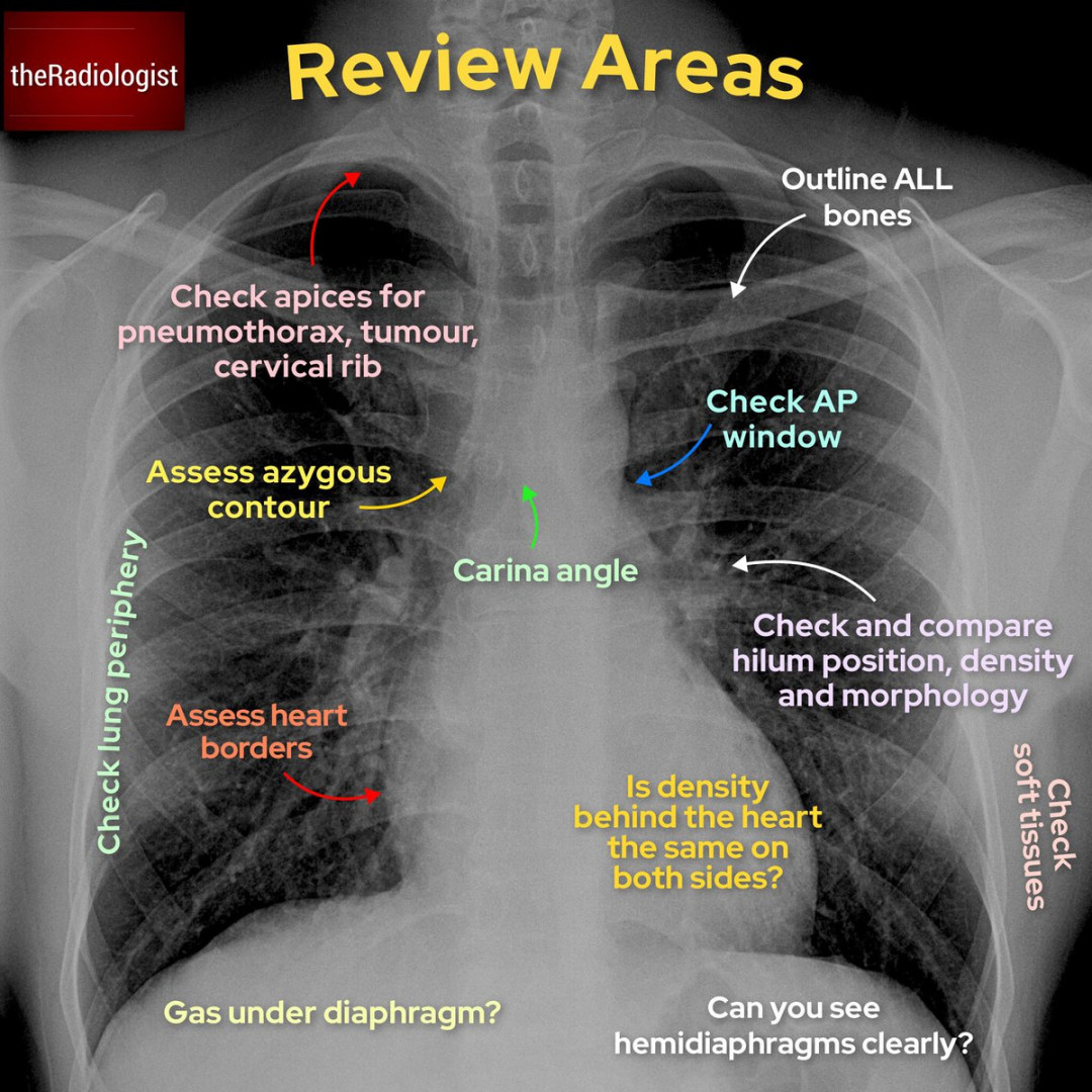 theRadiologist on X: "BASICS: Chest X-Ray anatomy and review areas